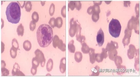 骨髓纤维化最新突破，开启疾病治疗新篇章